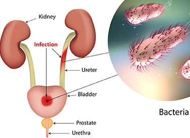Urinary Tract Infection (UTI): Symptoms, Causes, Treatments