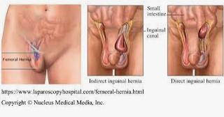 Femoral Hernia on Female Body – Medical Stock Images Company